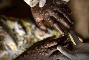 OMS afirma que Angola é o segundo país africano com mais caso de MPOX
