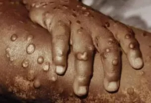 Cabinda regista primeiro caso de morte por Mpox